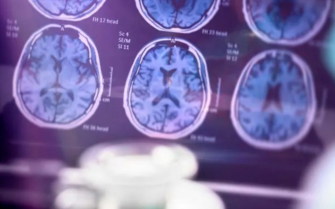 Identifican una nueva diana contra el Alzheimer