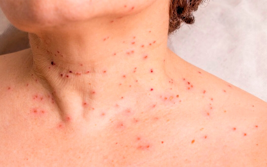 Test gratuitos de OSEP para detectar el virus de papiloma humano