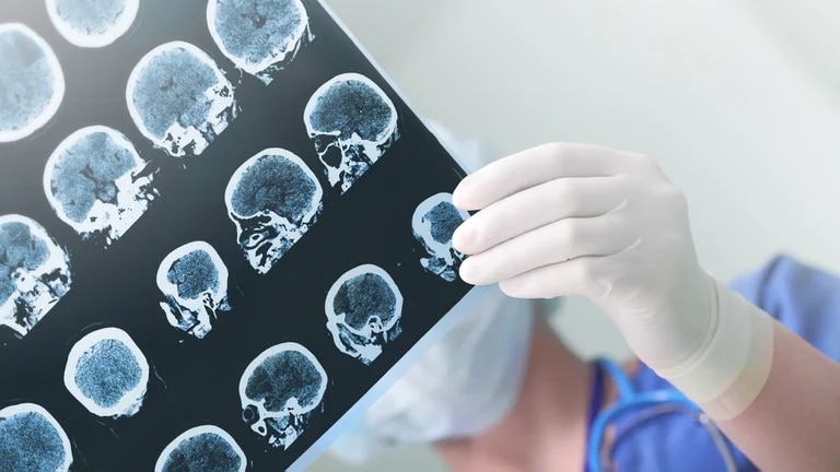 Epilepsia-Tratamiento Farmacológico