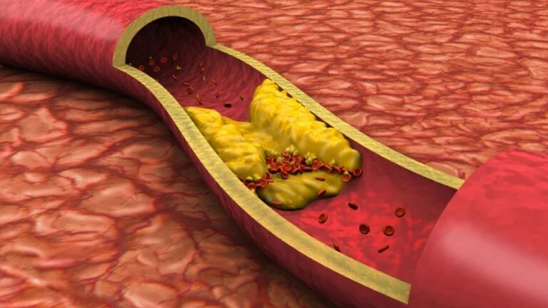 Argentinos y españoles detectaron una proteína que puede prevenir la aterosclerosis y el aneurisma