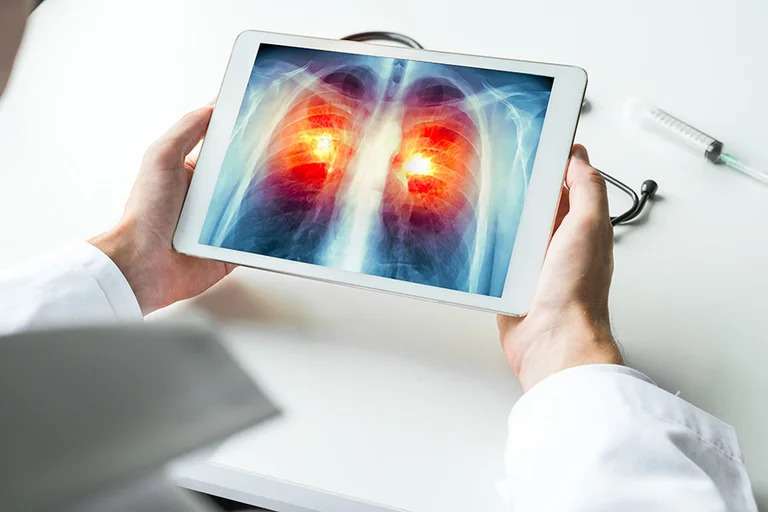 propagación cáncer de pulmón