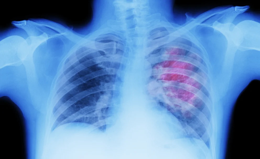 Aprueban en la Argentina un nuevo fármaco para tratar un tipo de cáncer de pulmón muy agresivo