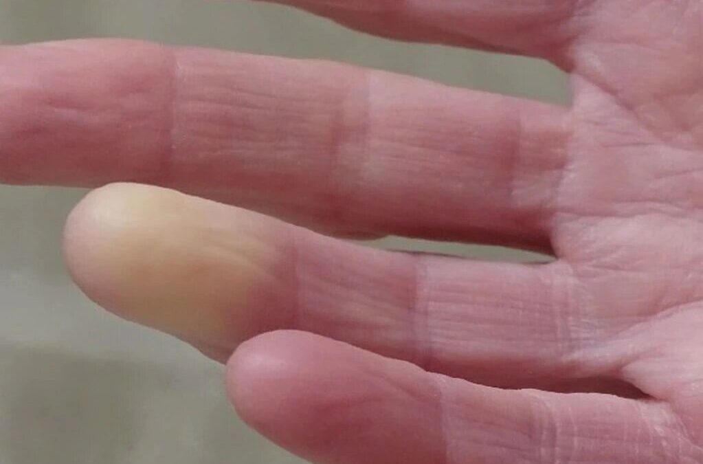 Qué es la esclerodermia