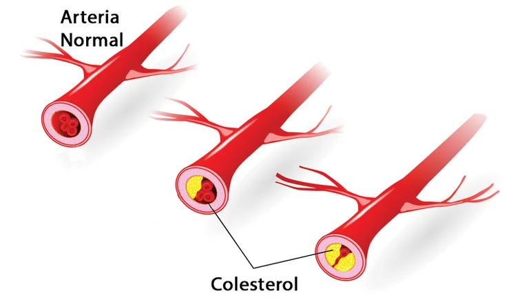 Colesterol en sangre