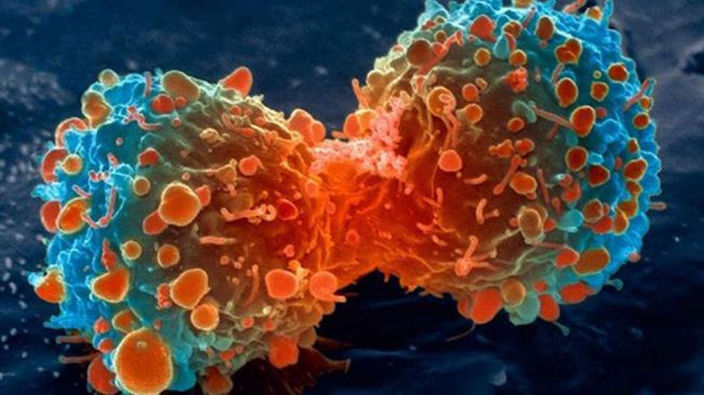 Tipos y estadios cáncer de pulmón