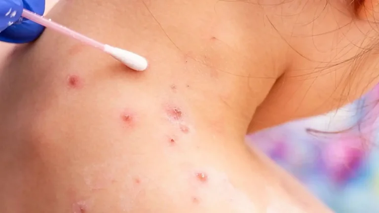 Las huellas de la viruela del mono en la piel: cómo prevenir y tratar las cicatrices