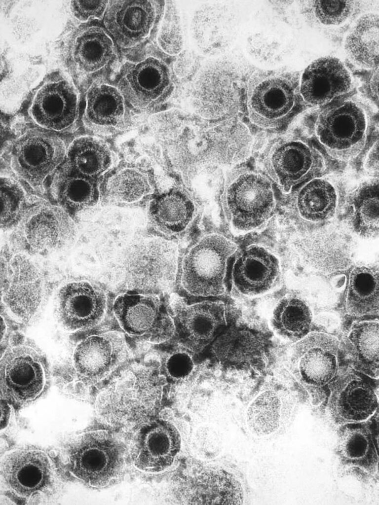 El virus del Herpes puede ser una de las causas de la encefalitis