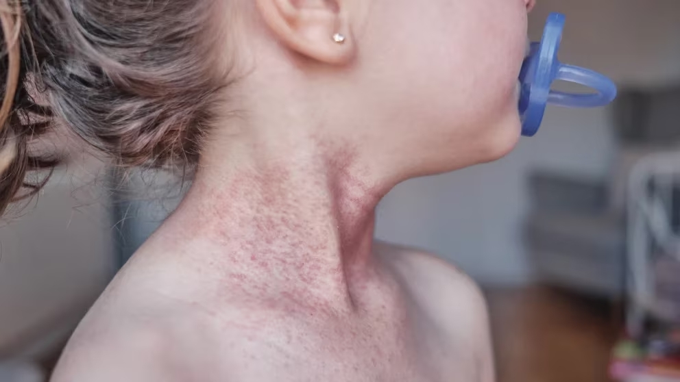 Dermatitis atópica: 6 de cada 10 niños con esta patología tienen comorbilidades asociadas