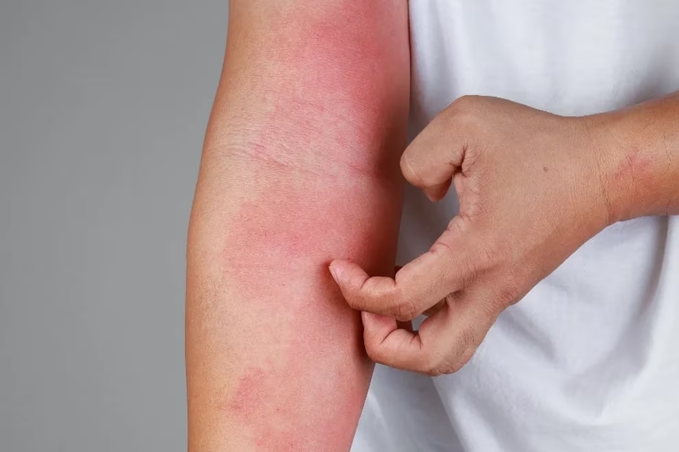 Picazón o inflamación puede ser señal de dermatitis atópica