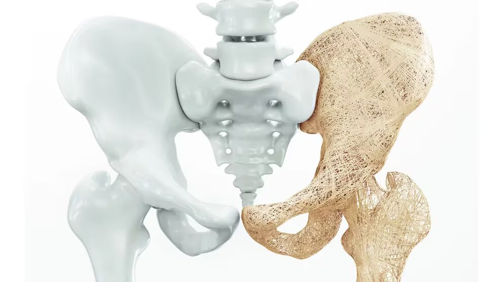 90 fracturas de cadera por osteoporosis