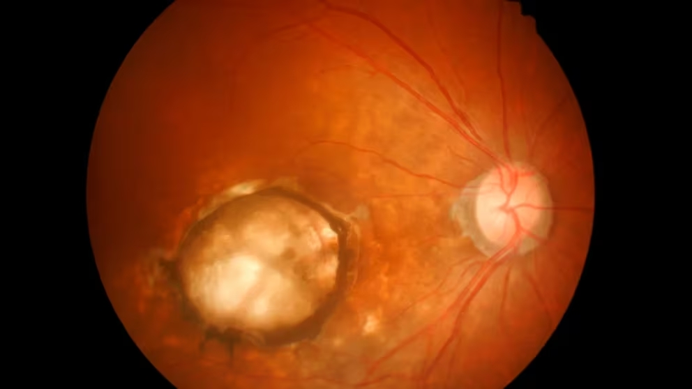 Edema macular diabético-Ceguera