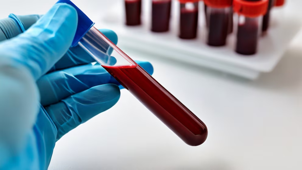Alta expresión de la proteína GAL1 en tumores